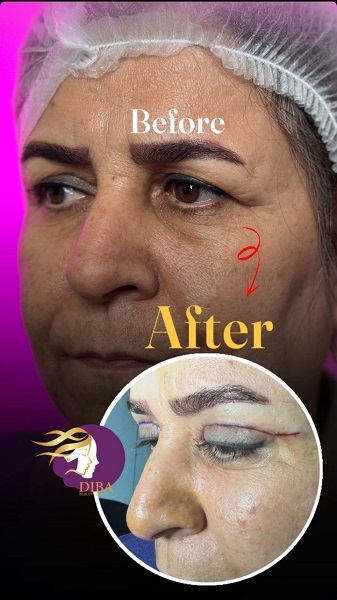 نمونه بلفاروپلاستی - دیبا