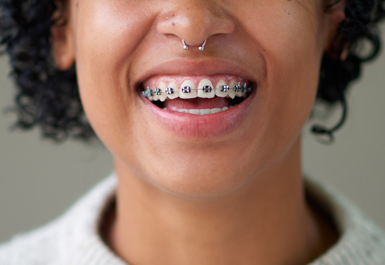 ارتودنسی کوتاه مدت چه کاربردهایی دارد؟