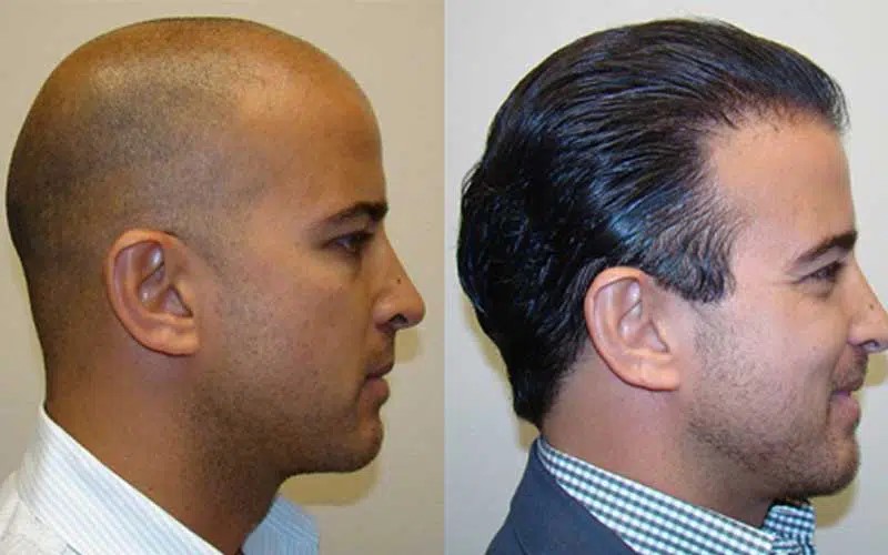 دلایل ریزش مو راهکارهای  درمانی