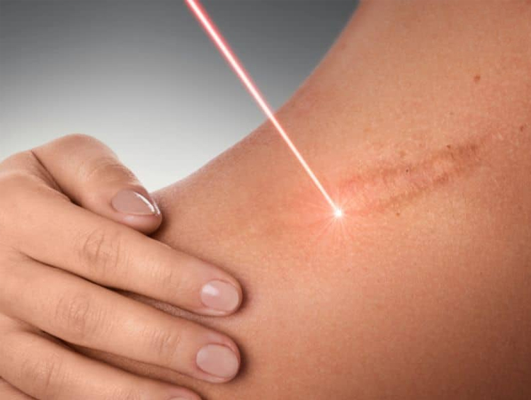 درمان جای زخم با سلول های بنیادی یا لیزر؛ کدام روش را انتخاب کنم؟