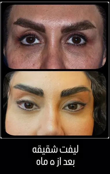 لیفت شقیقه دکتر سعید رجبیان