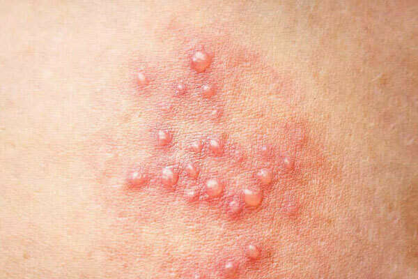 Male-genital-warts1-1