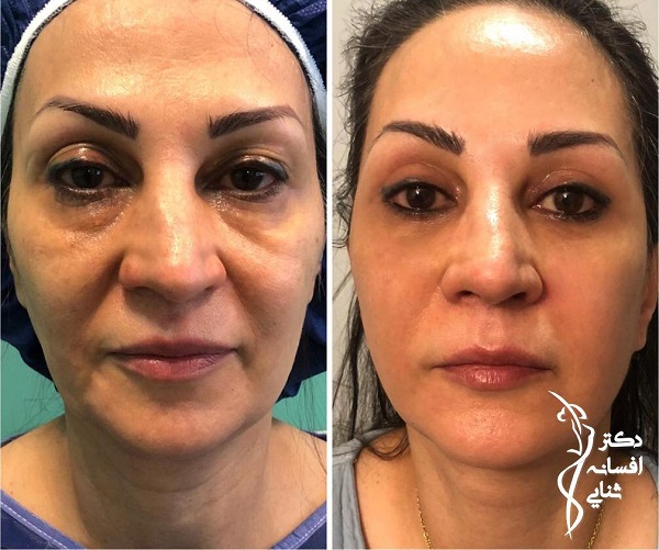 نمونه جوانسازی به روش نوراریژن - دکتر افسانه ثنایی