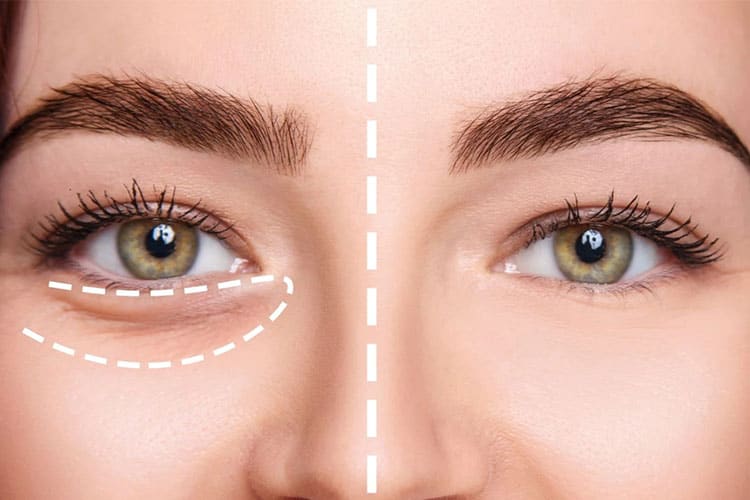 puffy-eyes-treatment