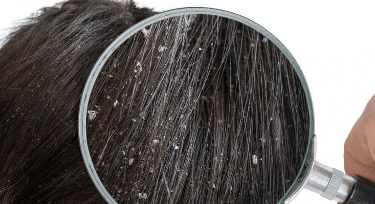 dandruff-involves-flakes-of-skin-that-collect-in-the-hair-min