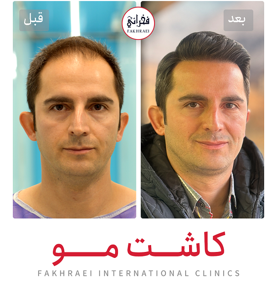 نمونه کاشت مو - کلینیک فخرایی