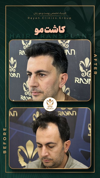 نمونه قبل و بعد جراحی پیوند مو در کلینیک رایان سلامت