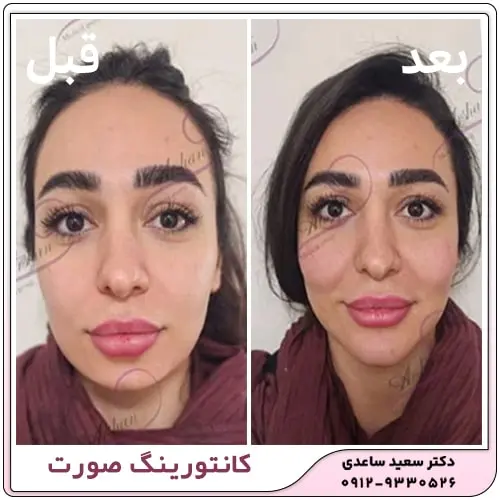 Facial-contouring-work-example-3