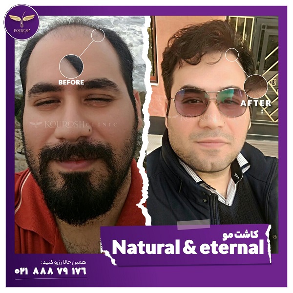 بهترین کلینیک کاشت مو در تهران
