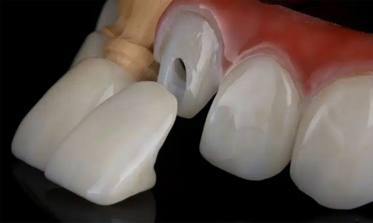 انواع مواد روکش دندان