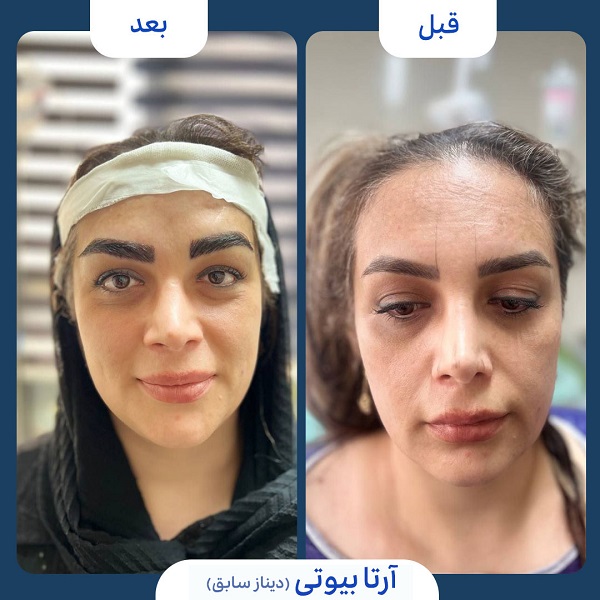 نمونه قبل و بعد کاشت ابرو کلینیک آرتا بیوتی