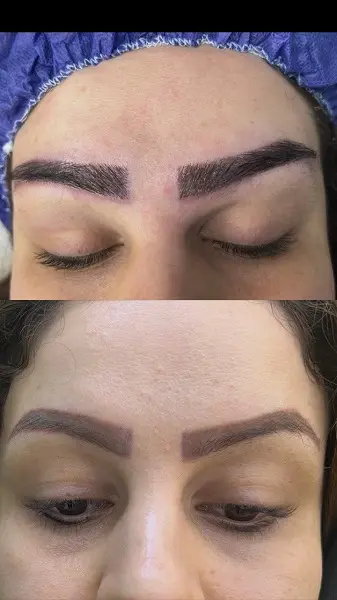 نمونه کاشت ابرو در کلینیک آرتان