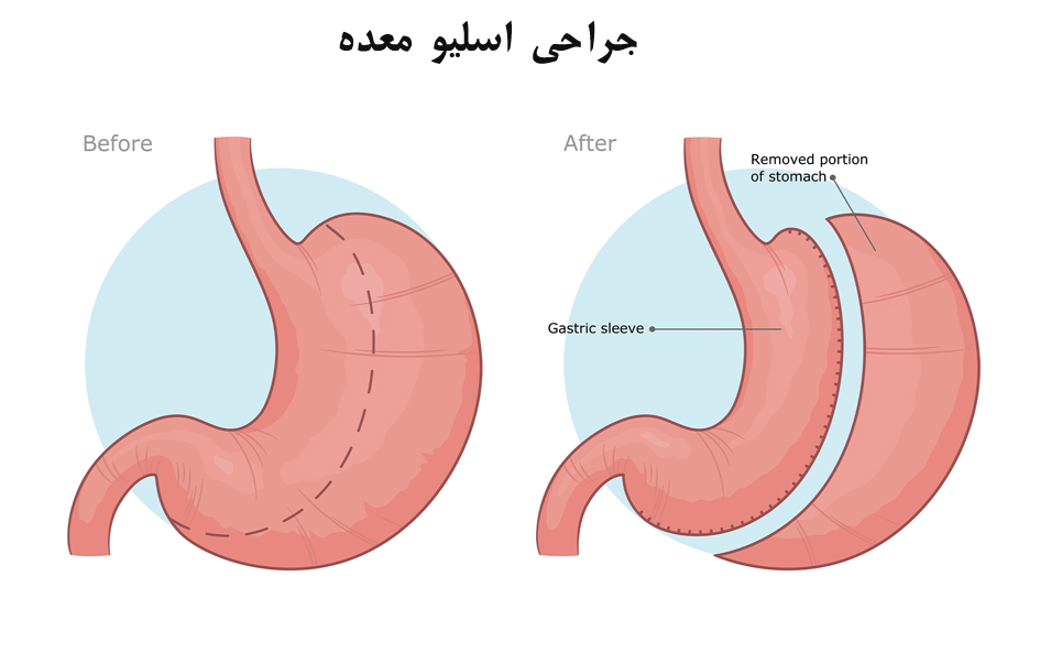 جراحی اسلیو معده