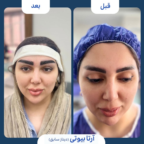 نمونه قبل و بعد کاشت ابرو کلینیک آرتا بیوتی