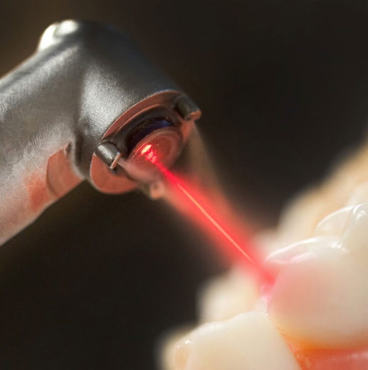 هزینه عصب کشی با لیزر