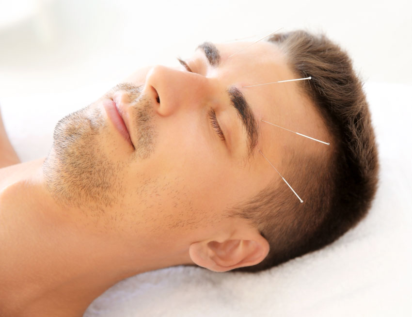 acupuncture-migraine