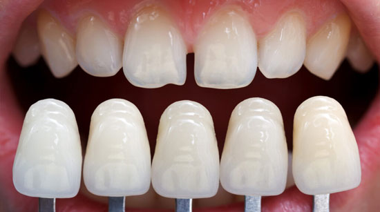 آیا لمینت دندان دائمی است؟ بررسی ماندگاری لمینت دندان