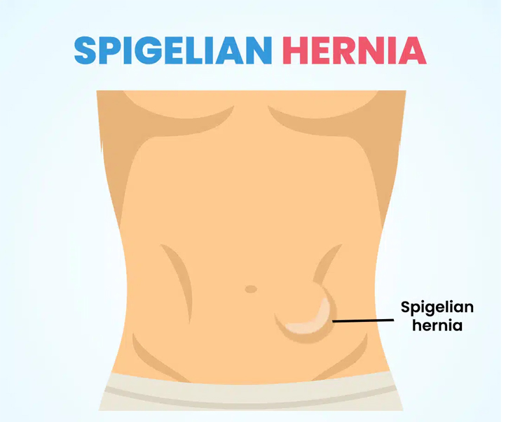 فتق اسپیژلین
