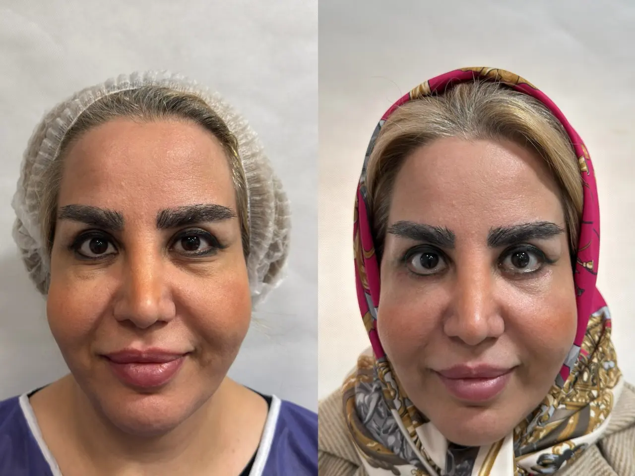 بلفاروپلاستی1