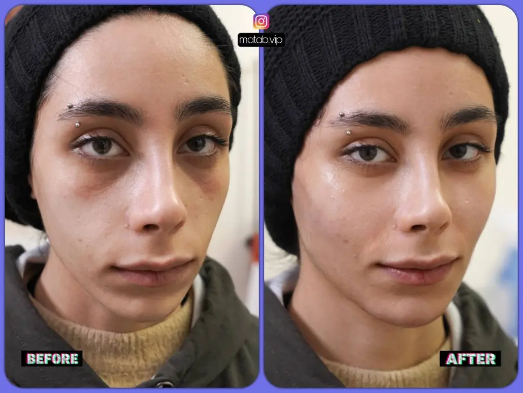 بهترین پزشک تزریق فیلر زیر چشم