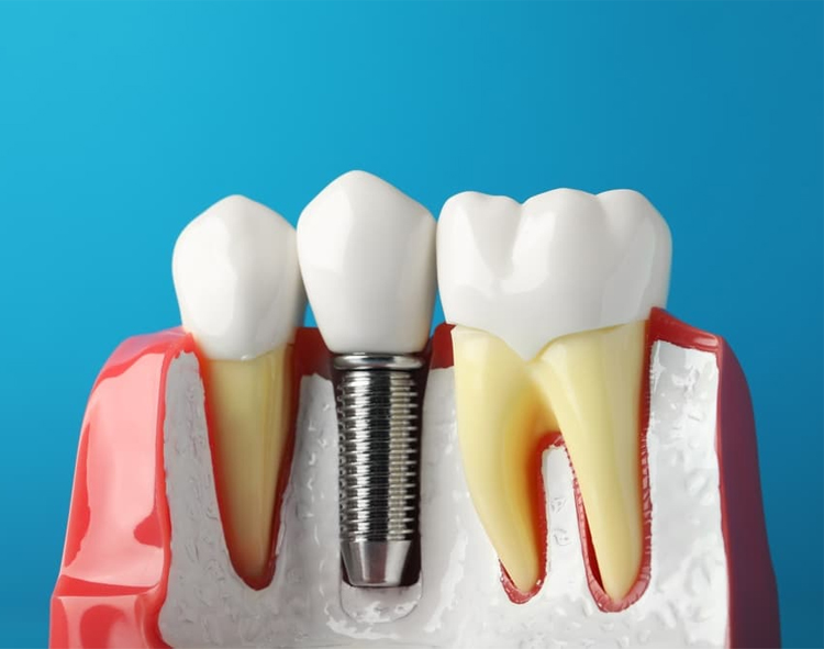 آیا برای انجام ایمپلنت می‌توان از بیمه استفاده کرد؟