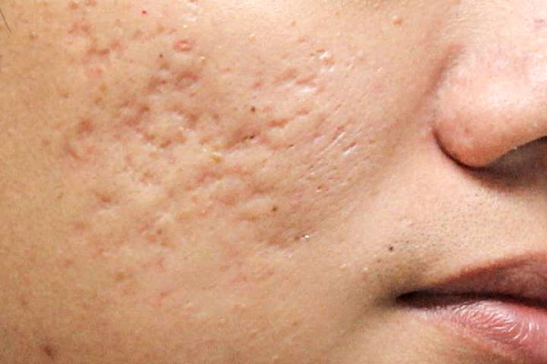 acne5-s