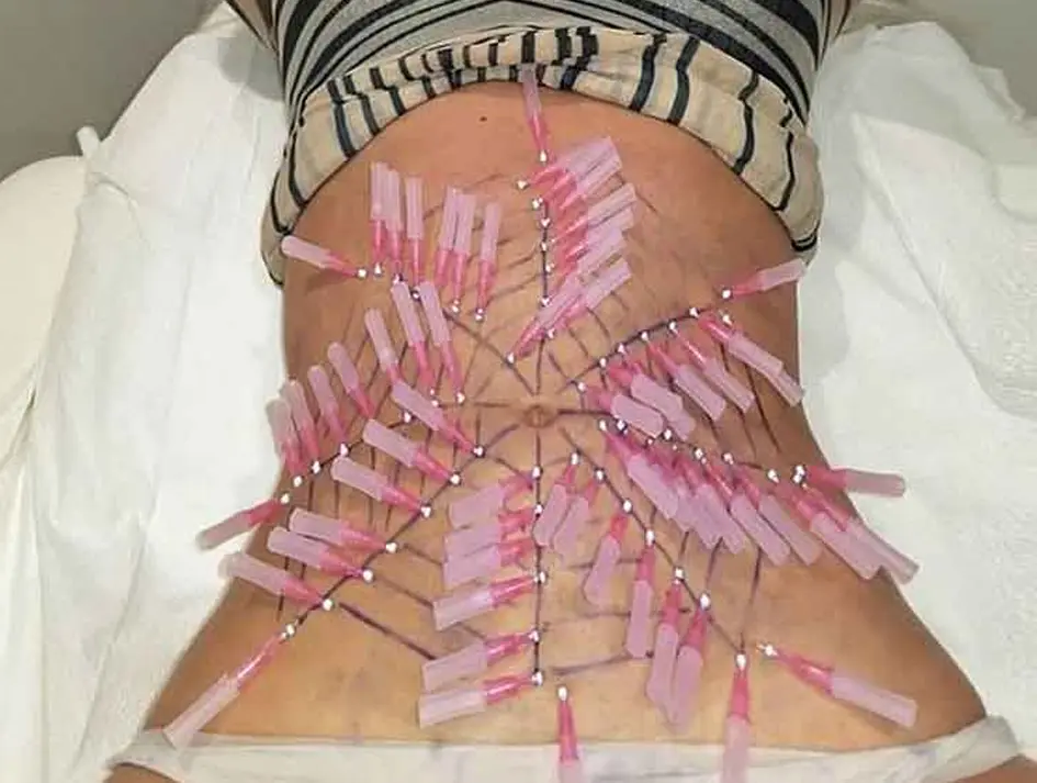 امبدینگ در کدام نواحی بدن قابل انجام است؟