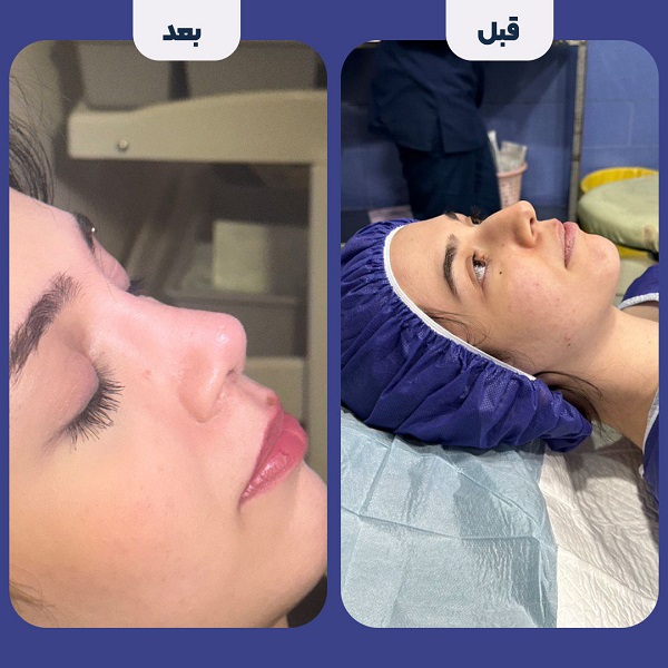 نمونه جراحی بینی دکتر محمد لاجوردی