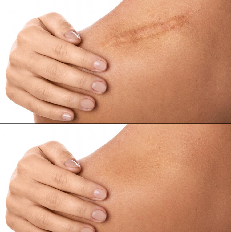 مقایسه درمان جای زخم با سلولهای بنیادی و لیزر؛ کدام مؤثرتر است؟