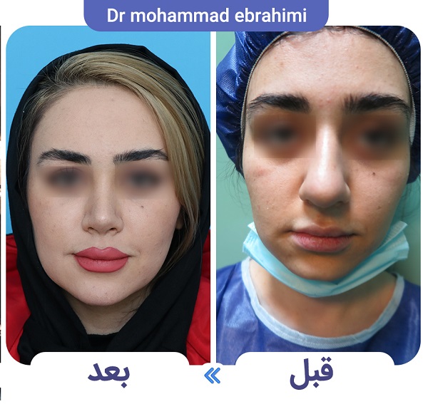 عمل جراحی بینی سربالا + ترمیم بینی خوکی