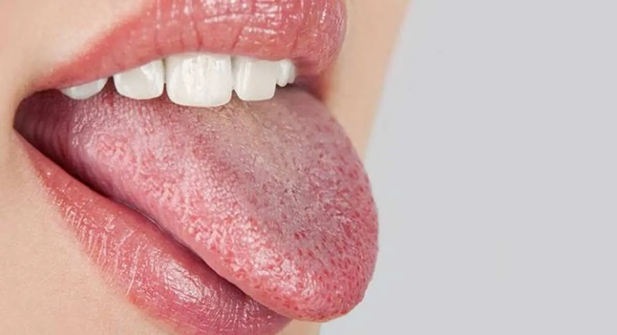 رنگ زبان شما چه هشداری درباره سلامت بدنتان می‌دهد؟