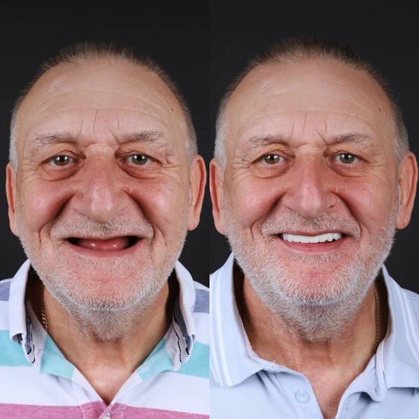 نمونه های ایمپلنت کامل فک به صورت اقساطی در دندانپزشکی ایثار
