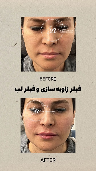 نمونه تزریق مزوژل - دکتر سوسن احمدی