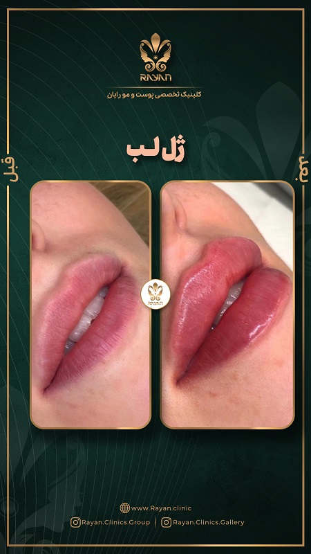نمونه تزریق ژل لب روسی در کلینیک رایان سلامت