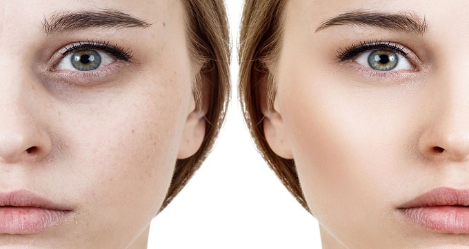 What-is-endolift-under-the-eyes-3
