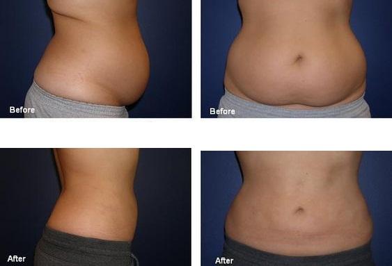 عمل-لیپوماتیک-یا-پیکرتراشی-چگونه-باعث-زیبایی-و-لاغری-می_شود؟