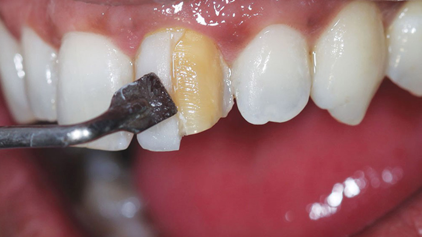 کامپوزیت و زیبایی دندان