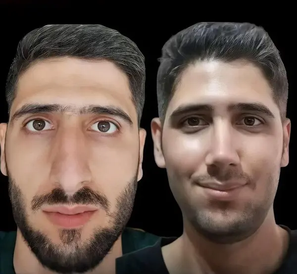 نمونه جراحی بینی دکتر سعید رجبیان