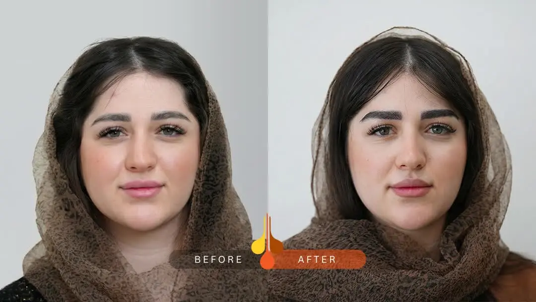 Hair-transplantation-method-NTF-5