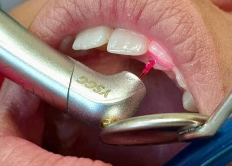 عصب کشی با لیزر چیست؟