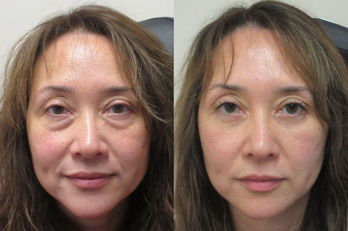 02_lower_lid_blepharoplasty