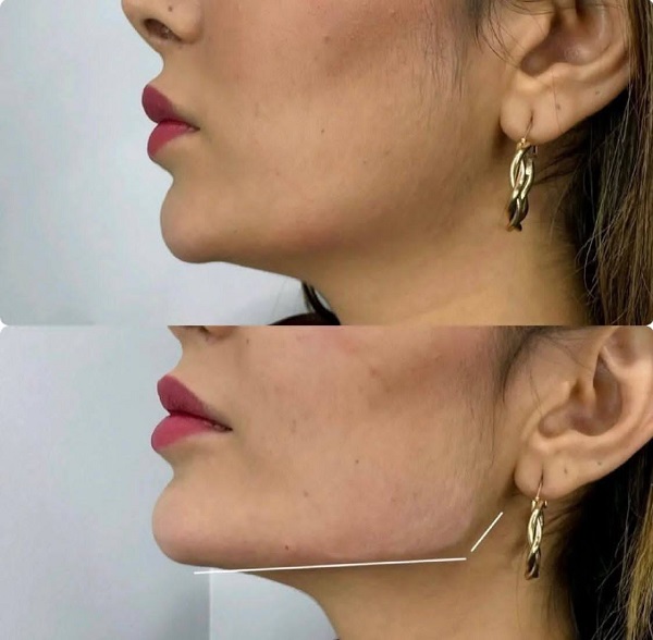 نمونه زاویه سازی صورت  - اسم بیوتی سنتر