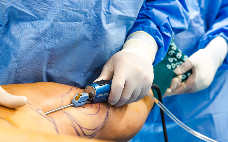 ویژگی بهترین جراح لیپوماتیک در تهران