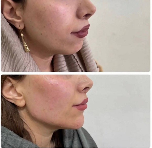 نمونه زاویه سازی صورت  - اسم بیوتی سنتر