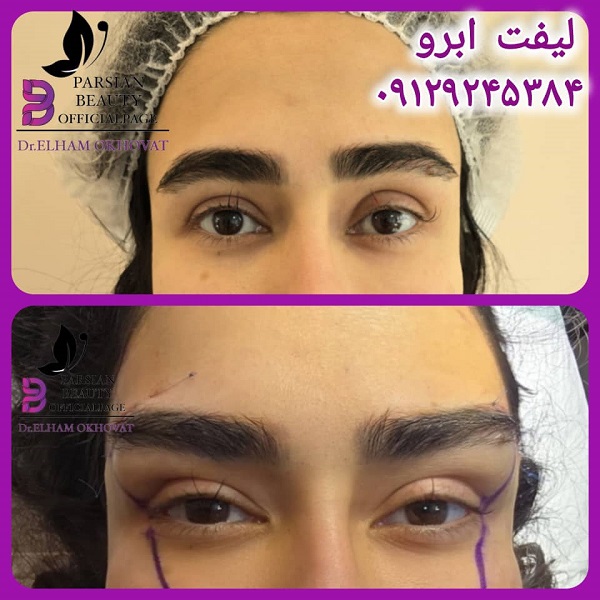 لیفت ابرو کلینیک پارسیان