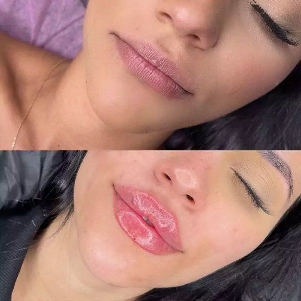 نمونه تزریق ژل لب روسی دکتر سمانه فتوحی