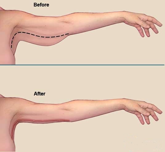 1494512662-arm-lift-surgery