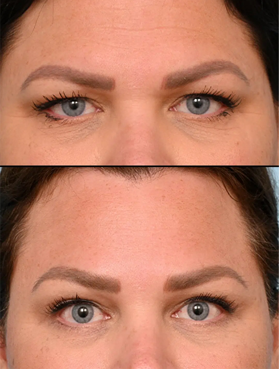 لیفت اندوسکوپی ابرو چه عوارضی دارد؟