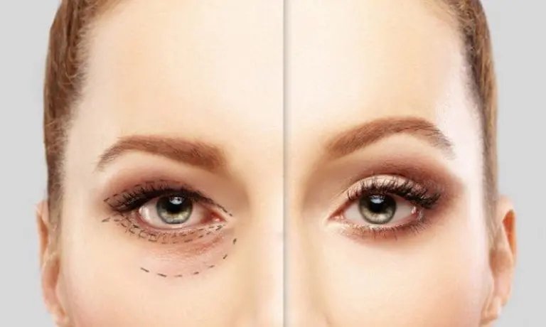 لیفت ابرو با اندوتاین