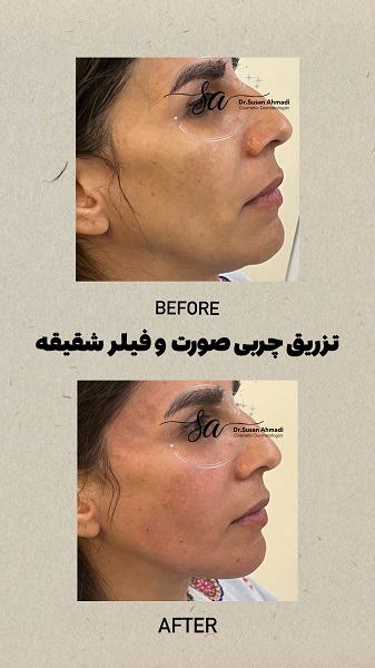 نمونه تزریق چربی - دکتر سوسن احمدی